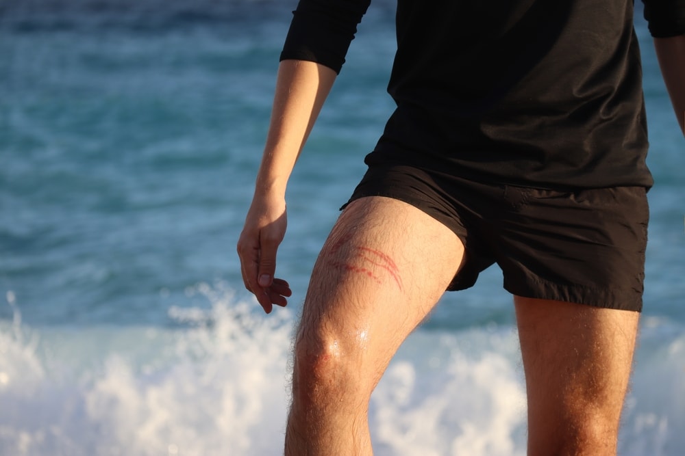 a jellyfish sting burn on a man's thigh